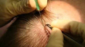 Uzmanından çarpıcı ’Kan sulandırıcı’ açıklaması: Saç ekimi masasından kalp krizleri geliyor