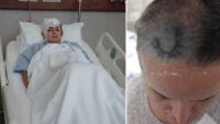 Diş ağrısı için gitti hayatı karardı. Şimdi beyninde ömür boyu cihazla yaşayacak