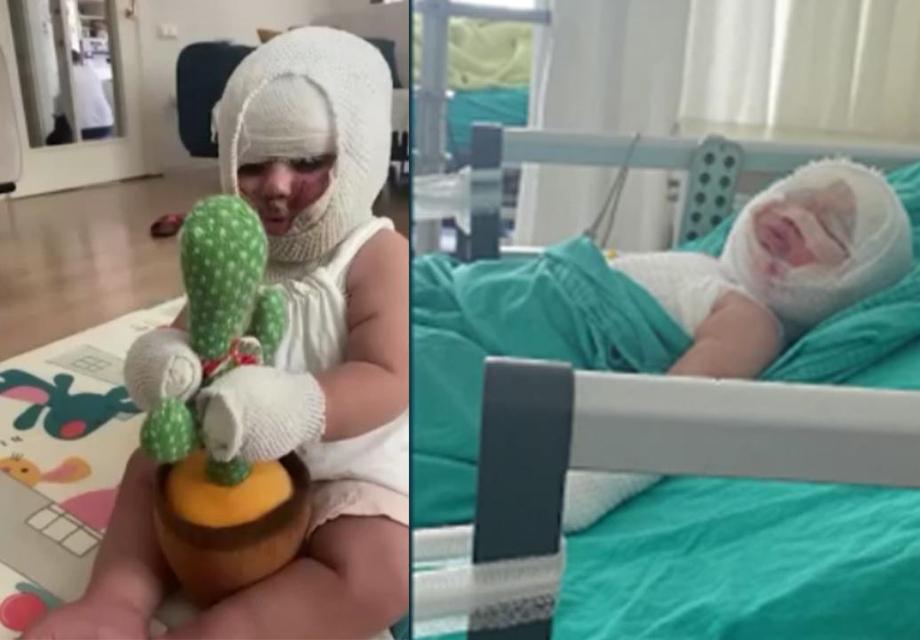 Domates konservesi bomba gibi patladı, 9 aylık bebeğin vücudu yandı
