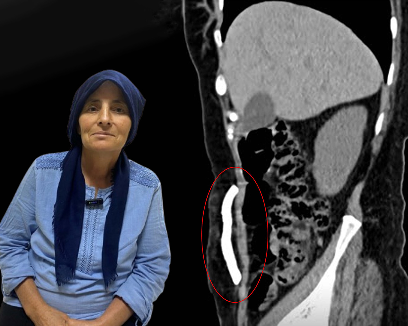 Manisa’da bir ilk. Karın boşluğunda aylarca kafatası kemiği taşıdı, sağlığına kavuştu