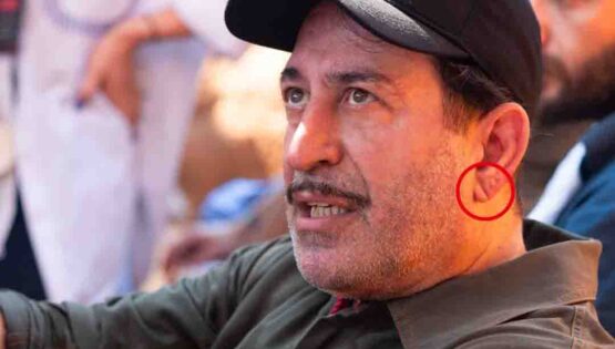 Kulak çizgisi kalp krizinin işareti mi? Cem Yılmaz’ın fotoğrafı tartışma yarattı