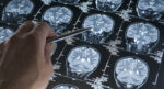 Alzheimer’da gençlik proteini keşfi