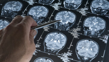Alzheimer’da gençlik proteini keşfi