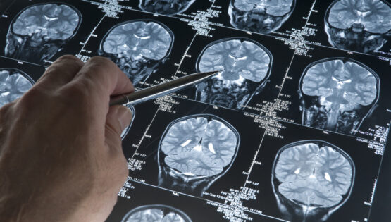 Alzheimer’da gençlik proteini keşfi