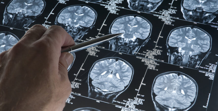 Alzheimer’da gençlik proteini keşfi